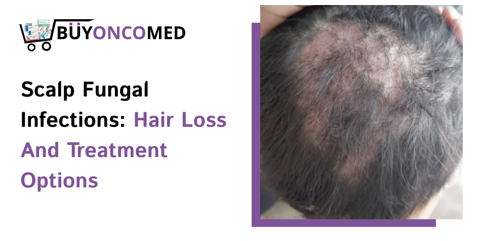 Scalp Fungal Infections Hair Loss and Treatment Options